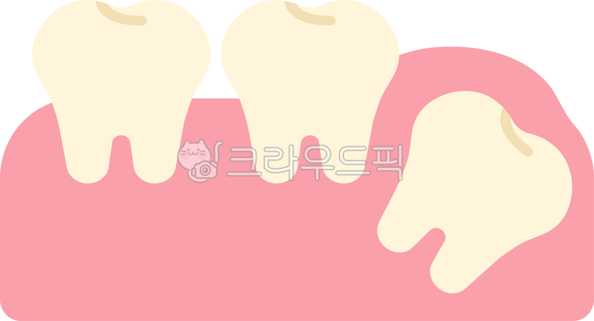 Impacted wisdom tooth,wisdom tooth,wisdom tooth extraction,wisdom tooth extraction,wisdom tooth pain,extraction,wisdom tooth rash,back molar,molar,wisdom tooth removal,dentistry,teeth,teeth,this,wisdomtooth,dental,dentist,tooth,teeth,gu