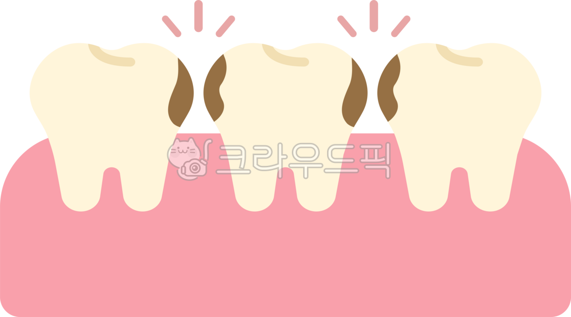 사이충치,치아사이충치,이빨사이충치,충치,상한이,썩은이,얕은충치,이빨,치아,치과,썩은치아,썩은이빨,충치일러스트,충치모형,충치삽화,치과치료,신경치료,충치신경치료,dental,dentist,cavity,tooth,teeth