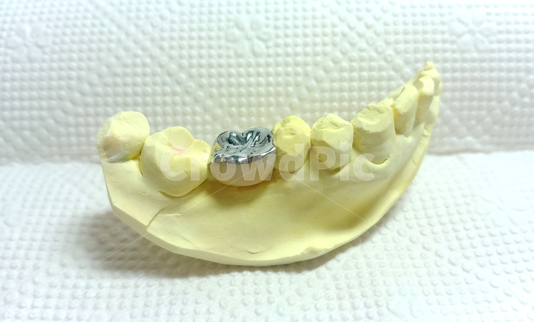 치과,덴탈,임플란트,보철,implant,어금니,대구치,dental