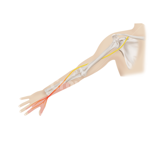 메디컬,medical,png,일러스트,메디컬일러스트,요골신경마비,신경,염증,병증,증상,요골신경,누끼,remove background