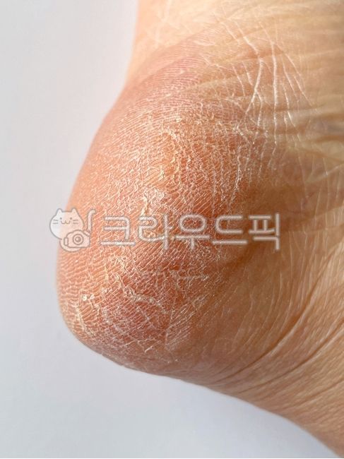 뒷꿈치각질,각질제거기,발각질제거,발뒤꿈치갈라짐,발각질제거기