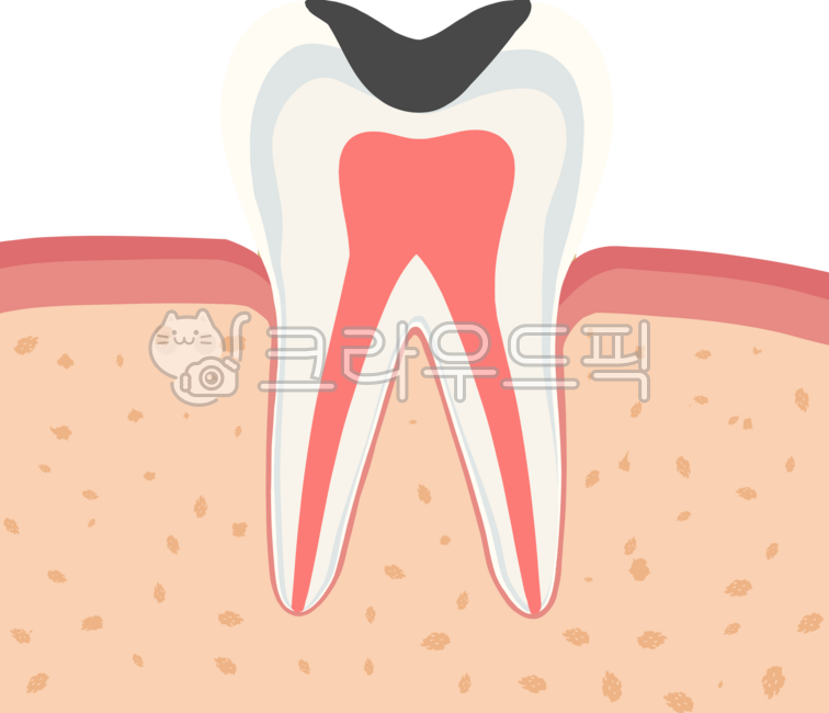 Molar,cavity,root canal,tooth,dentistry,inflammation,crown,inlay,resin,cervical area,abrasion,gums,periodontology