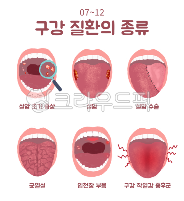 구강,질환,종류,설암,증상,수술,균열설,혀주름,혀,입,입술,치아,입천장,부음,통증,작열감,증후군,질병