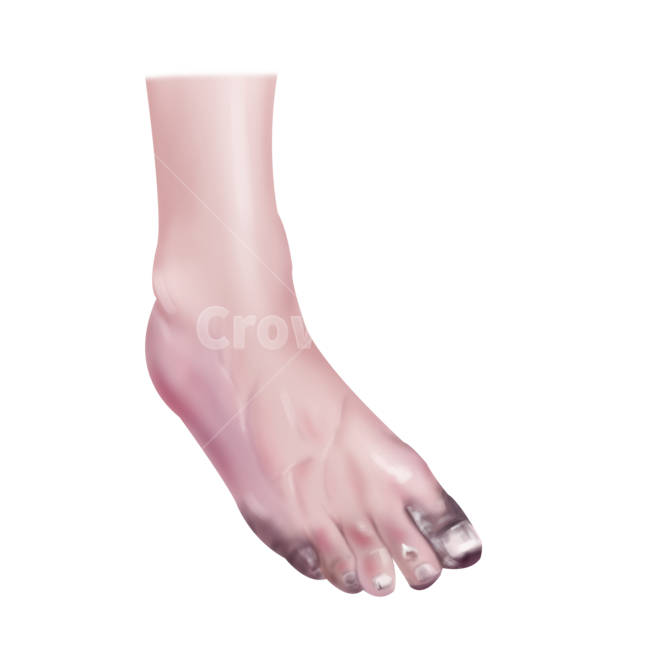 메디컬,medical,png,일러스트,메디컬일러스트,당뇨족,당뇨,합병증,증상,병증,질환,누끼,remove background