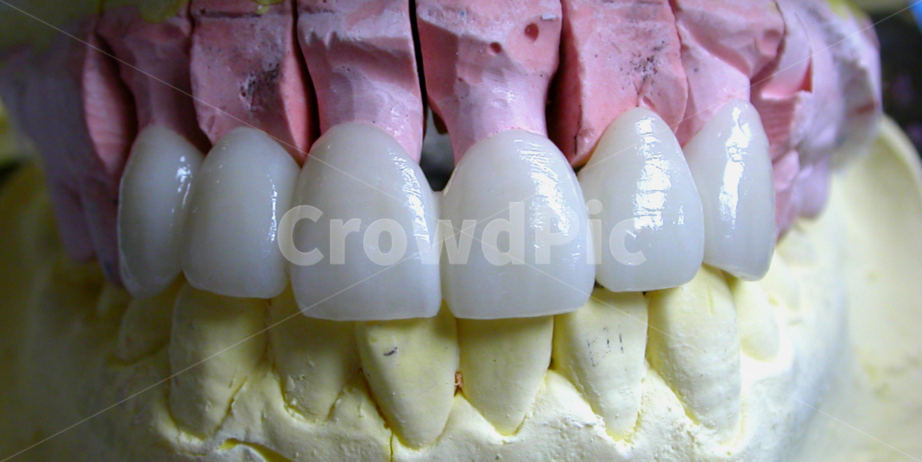 치과,보철,지르코니아,이빨,덴탈,zirconia,앞니,중절치,치아
