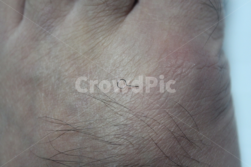 skin,피부,침,피내침,건강,의료,의학,병원,medical,hospital,clinic