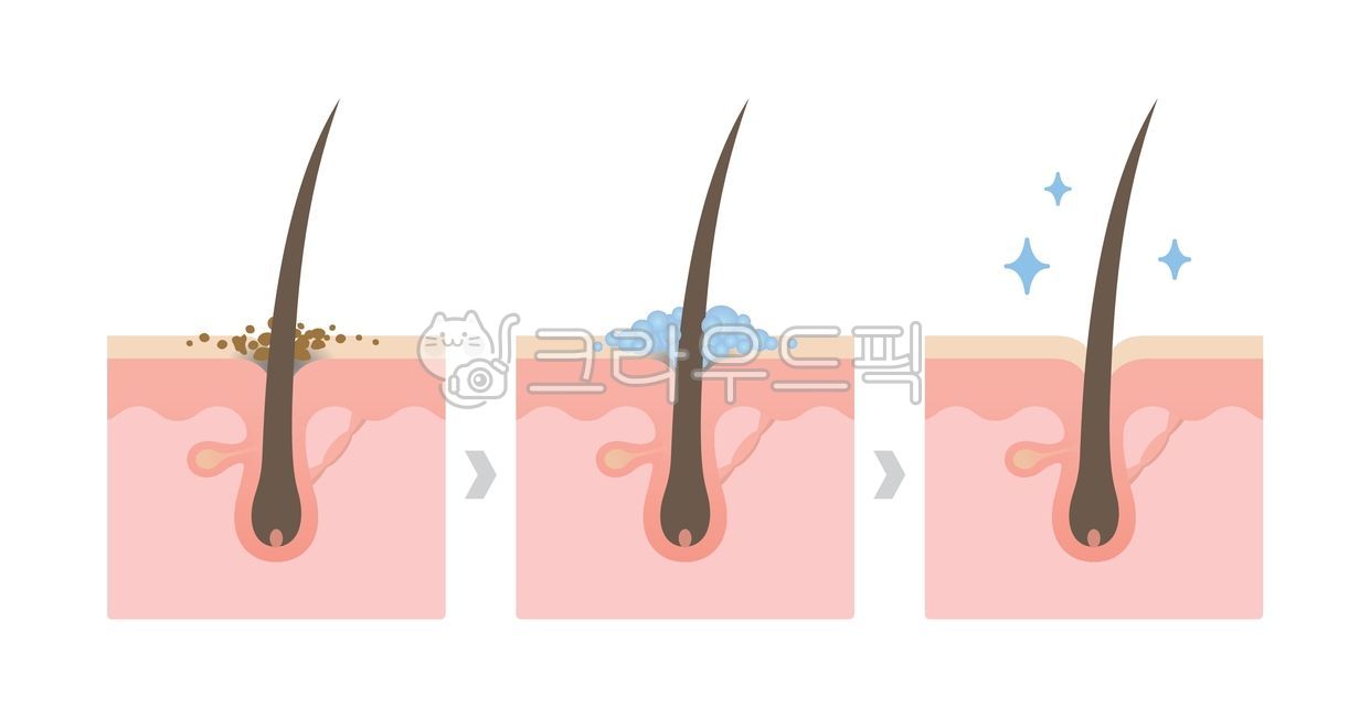 모발,비듬,머리카락,헤어,클렌징,각질,모근,트러블,샴푸,스케일링,케어,세균,막힌,씻는,때,헤어케어,깨끗한,전후,비교,더러운,문제,비포에프터,변화,과정,모낭,털,두피,표피,진피,표면,피부,일러스트,일러스트레이션,인포그래픽,해부도,구조,부위,단면,레이어