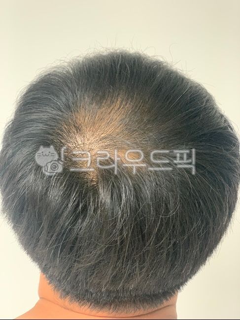 탈모,헤어,모발,모발이식,얇은모발,뒷통수,원형탈모,머리카락,hair