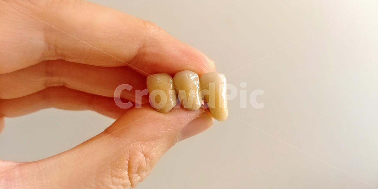 치과,보철,지르코니아,이빨,보험,구강,덴탈