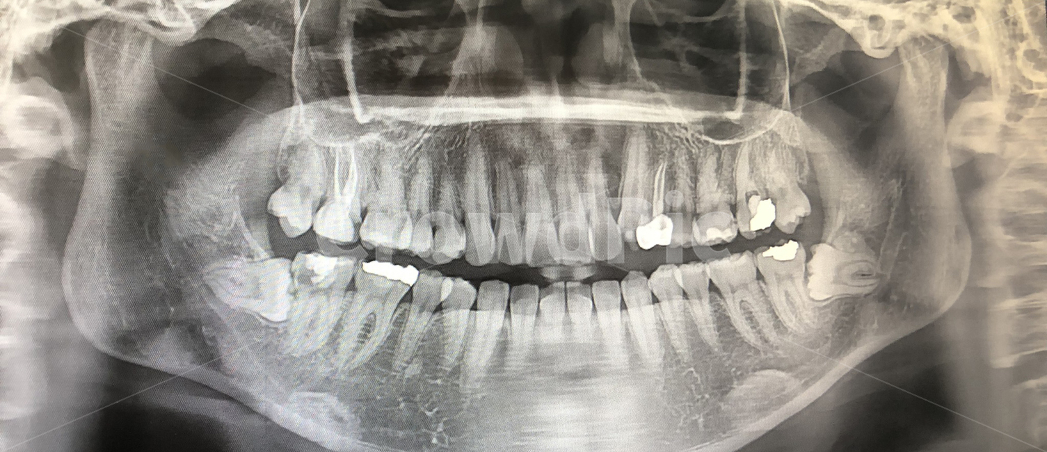 Impacted wisdom teeth,dental xray,Dentist,Paranoma,xray,cavity,wisdom tooth,correction