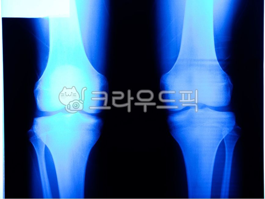 hospital film,xray,bone,knee bone,video film
