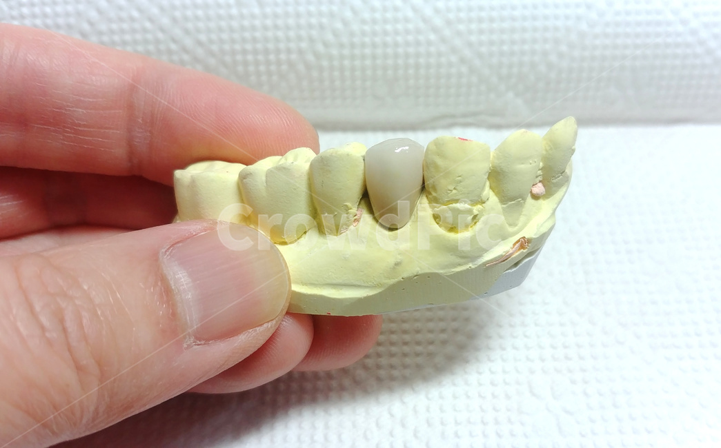 치과,보철,치아,치과기공사,dental,소구치,인공치아,이빨
