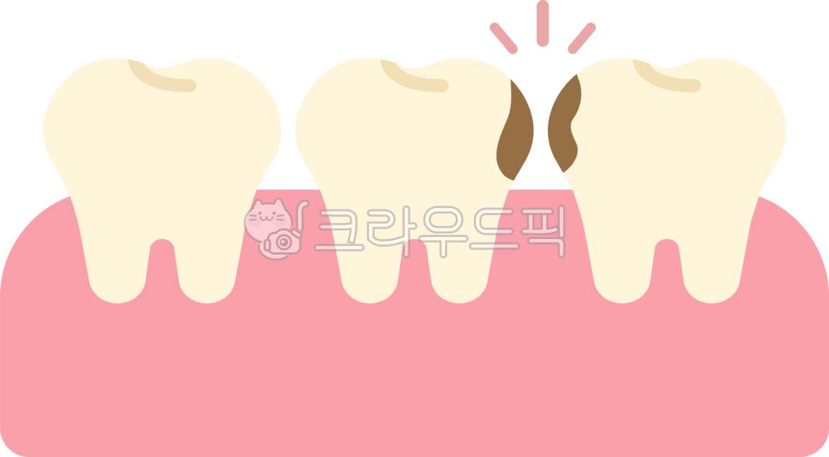 Cavity between teeth,cavity between teeth,cavity between teeth,cavity,upper limit,rotten tooth,shallow cavity,tooth,teeth,dentistry,rotten tooth,rotten tooth,cavity illustration,cavity model,cavity illustration,dental treatment,root canal 
