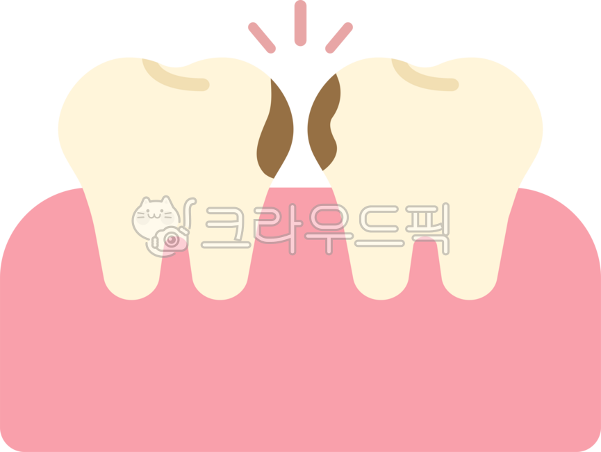 Cavity between teeth,cavity between teeth,cavity between teeth,cavity,upper limit,rotten tooth,shallow cavity,tooth,teeth,dentistry,rotten tooth,rotten tooth,cavity illustration,cavity model,cavity illustration,dental treatment,root canal 