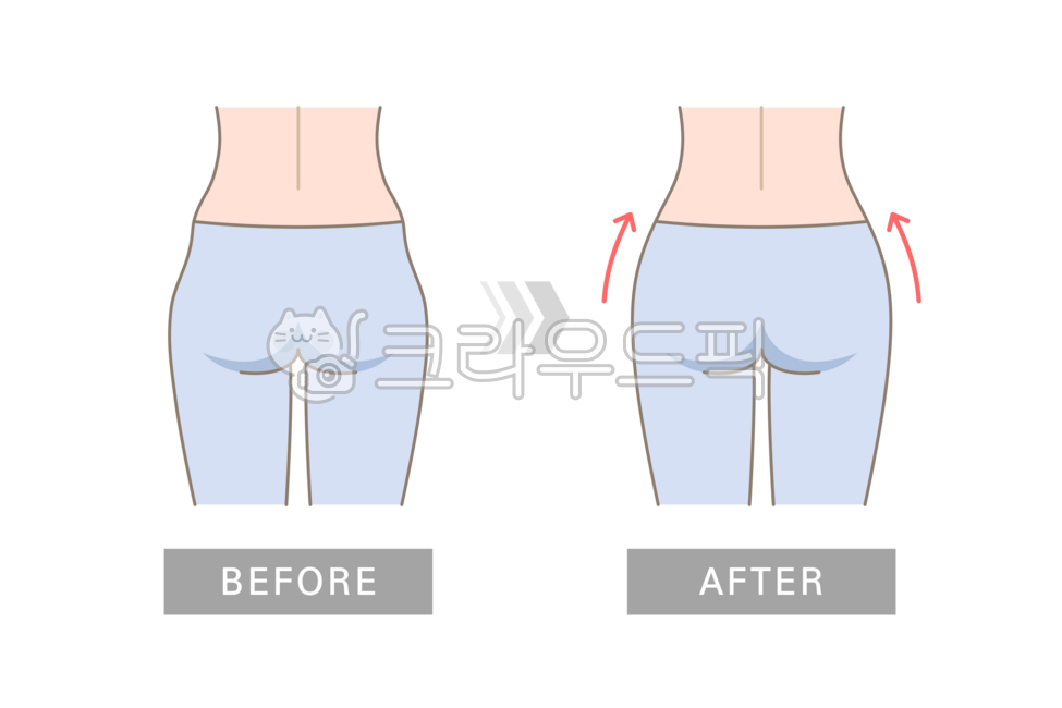 Hip dip,flexion,hip joint,gluteus medius,pelvis,body,human body,person,model,appearance,line,side,side view,filled,pretty,fitness,exercise,health,beauty,surgery,change,comparison,before and after,before and after,back,back view
