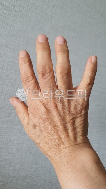 손가락관절염,류마티스관절염,손가락퇴행성관절염,건버섯,검버섯,손,손가락,엄마손,고생한손,hand,rheumatoidarthritis,arthritis,jointinflammation