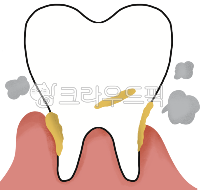치과,치아,치과질환,잇몸질환,치주질환,구강,구강질환,치아일러스트,periddontitis,porketdepth,치근,gum,gingiva,치석,치은,치주연하,치주연상,잇몸일러스트,치과일러스트,치주질환증상,치과치료,치주병,치은염,치주염,충치,충치치료,입냄새