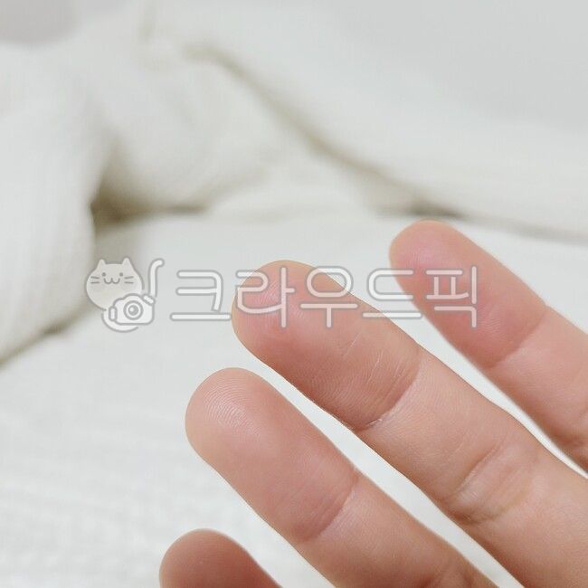 finger,burn,blister,person,human,finger blisters,hand