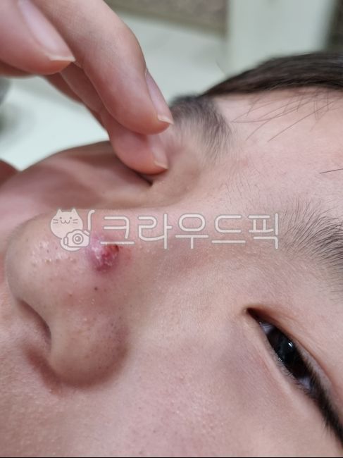 코,여드름,코여드름,여드름짜기,피부병,청소년피부,아동피부,피부과,얼굴,person,사람,skin,피부,신체부위