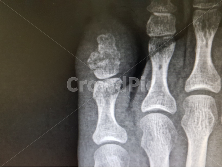 xray,병원,골절,발가락,뼈,의료,치료,환자,기브스,보험,건강,건강보험,안전사고,과실,의료,의학,병원,medical,hospital,clinic