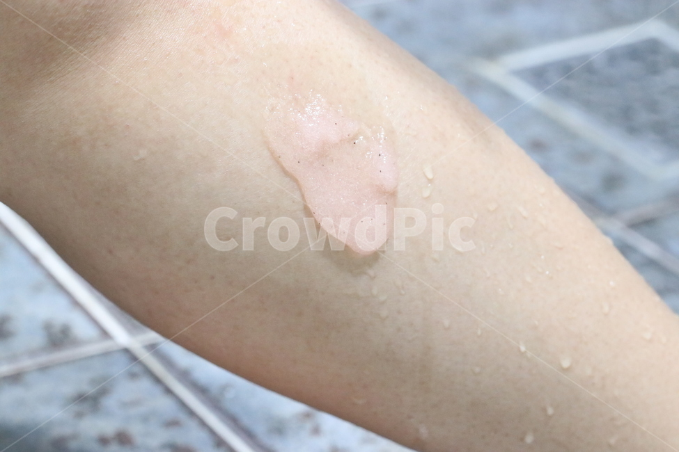 스크럽,각질제거,닭살,각질,피부,skin,다리,사람,인물,인간,human,person,신체일부,몸,body