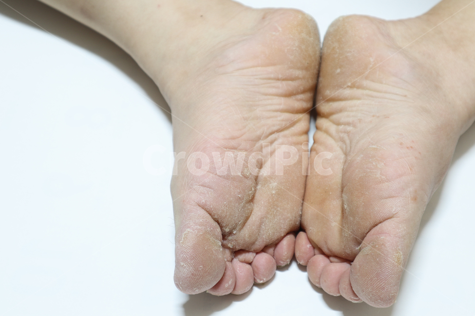 무좀,습진,각질,질병,발,신체,몸,의료,목욕,치료,발가락,피부,피부병,사람,인물,인간,human,person,신체일부,몸,body,의료,의학,병원,medical,hospital,clinic