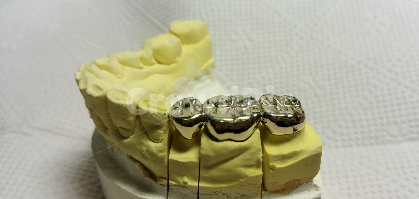 치과,덴탈,보철,금니,골드크라운,crown,gold,dental,치과기공사