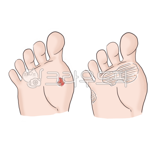 티눈,굳은살,발,발모양,발바닥,발가락,병원,신체,신체부위,몸,body,corn,callus