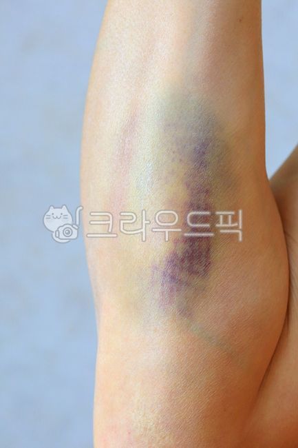 멍,타박상,상처,피멍,멍자국,팔,통증,신체일부,부상,고통,아픈,피부,피,폭행,외상,medical,손상,고통스러운,bruise,fracture,의료,arm