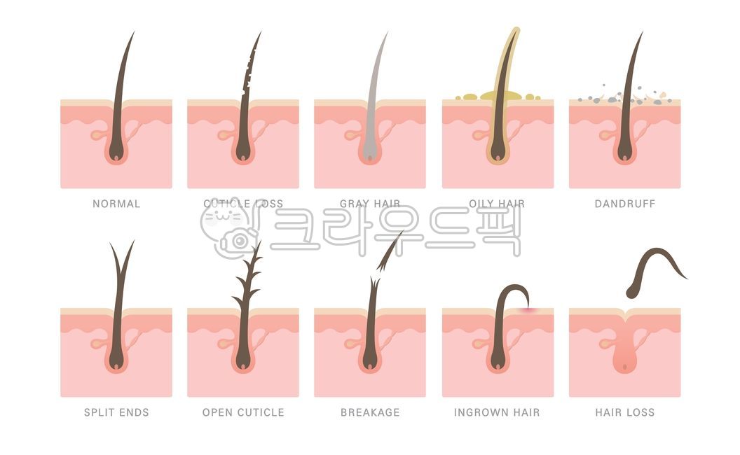 hair,problem,trouble,damage,split,hair loss,hair root,hair follicle,hair,hair,gray hair,gray hair,dandruff,keratin,oil,ingrown,hair loss,hair,scalp,epidermis,various,many,kind,type,dermis,surface,skin