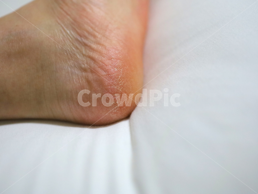 toe,발가락,발바닥,발,여자,people,인간,human,살,살색,피부,각질,의료,의학,병원,medical,hospital,clinic