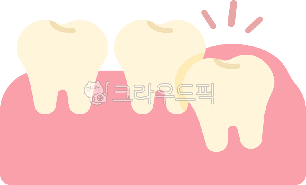 매복사랑니,사랑니,사랑니발치,사랑니추출,사랑니통증,발치,사랑니발진,뒷어금니,어금니,사랑니제거,치과,이빨,치아,이,wisdomtooth,dental,dentist,tooth,teeth,잇몸,치과치료,충치치료