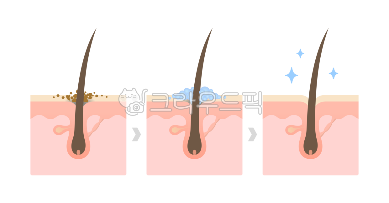 모발,비듬,머리카락,헤어,클렌징,각질,모근,트러블,샴푸,스케일링,케어,세균,막힌,씻는,때,헤어케어,깨끗한,전후,비교,더러운,문제,비포에프터,변화,과정,모낭,털,두피,표피,진피,표면,피부,일러스트,일러스트레이션,인포그래픽,해부도,구조,부위,단면,레이어