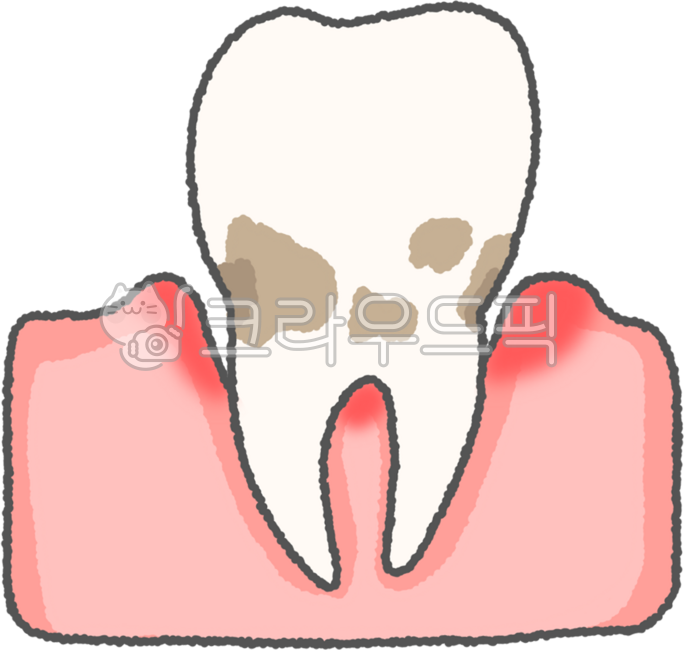 치아,이빨,치과,치과진료,치아보험,치과보험,치아관리,치과의사,치과치료,치주염,치석,치주질환,치은염,치통,이시림,치아빠짐,이빠짐,치아손실,치아상실,잇몸질환