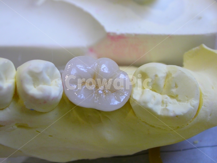 치과,의학,치아,이빨,보철,성형,앞니,금,골드,gold,병원,어금니,치과기공,porcelain,implant,임플란트,치과기공사,직업,의료기사,의사,치괴의사,의료,의학,병원,medical,hospital,clinic,사물,물건,오브젝트,thing,object,matter
