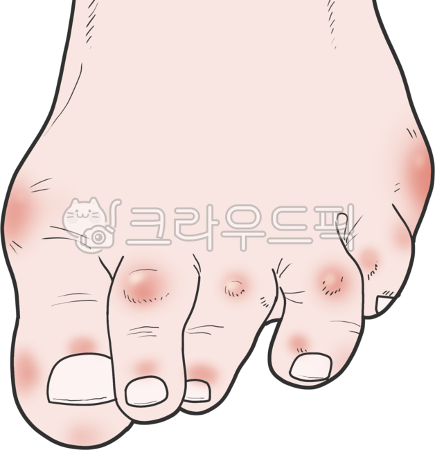 Ankle,disease,rheumatoid arthritis,foot,toes
