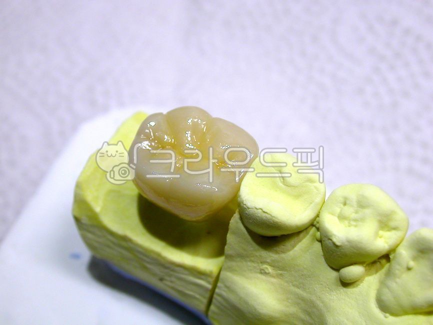 치과,덴탈,보철,지르코니아,zirconia,dental,어금니,대구치,세라믹,치과기공사