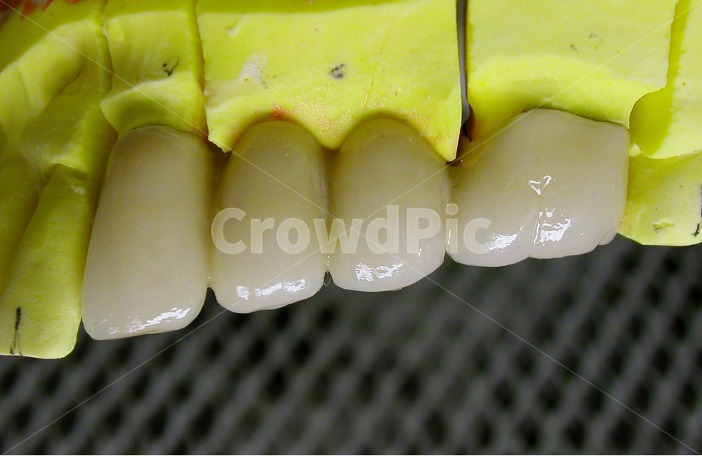 치과,의료,치과기공,치아,이빨,성형,dental,앞니,도자기,보철,포세린,의료,의학,병원,medical,hospital,clinic,사물,물건,오브젝트,thing,object,matter