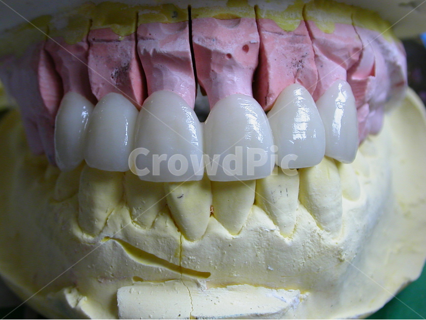 치과,치아,이빨,도자기,의료,porcelain,성형,브릿지,의료,의학,병원,medical,hospital,clinic,사물,물건,오브젝트,thing,object,matter