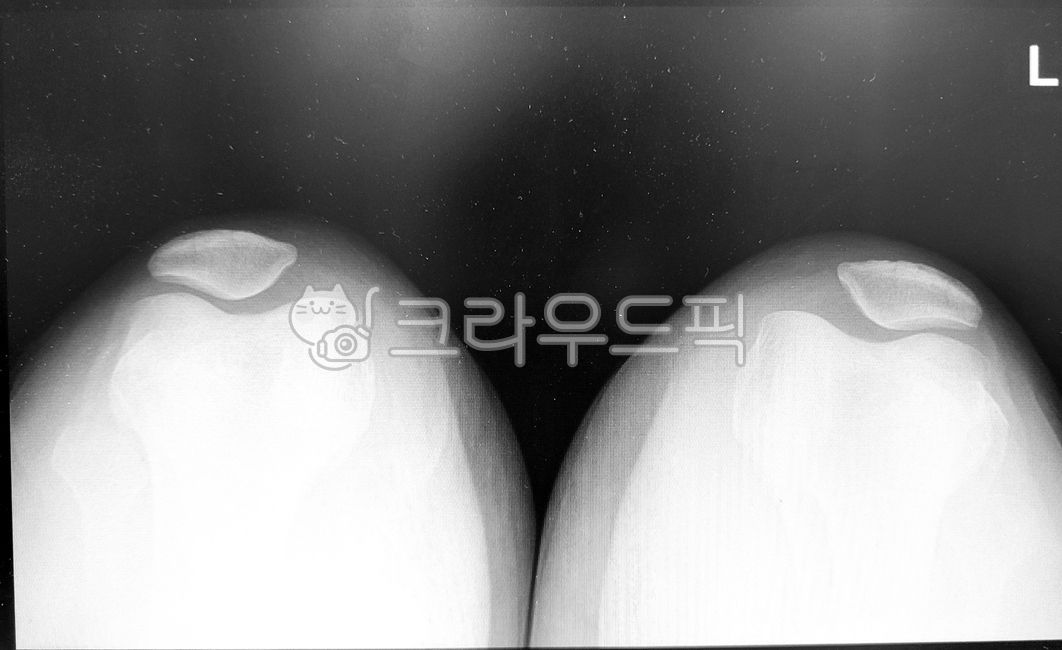 엑스레이,xray,hand,병원,검사,x선,뼈,orthopedics,정형외과,무릎,무릎뼈,medical,bones,의학,골절,관절,연골,슬골,병원검사,방사선,방사능,영상의학,patella,영상의학과,bone,fracture,pain,해부학,골화,anthropotomy,골격,무릎관절,골격계,근골격계,슬개골,슬관절외과