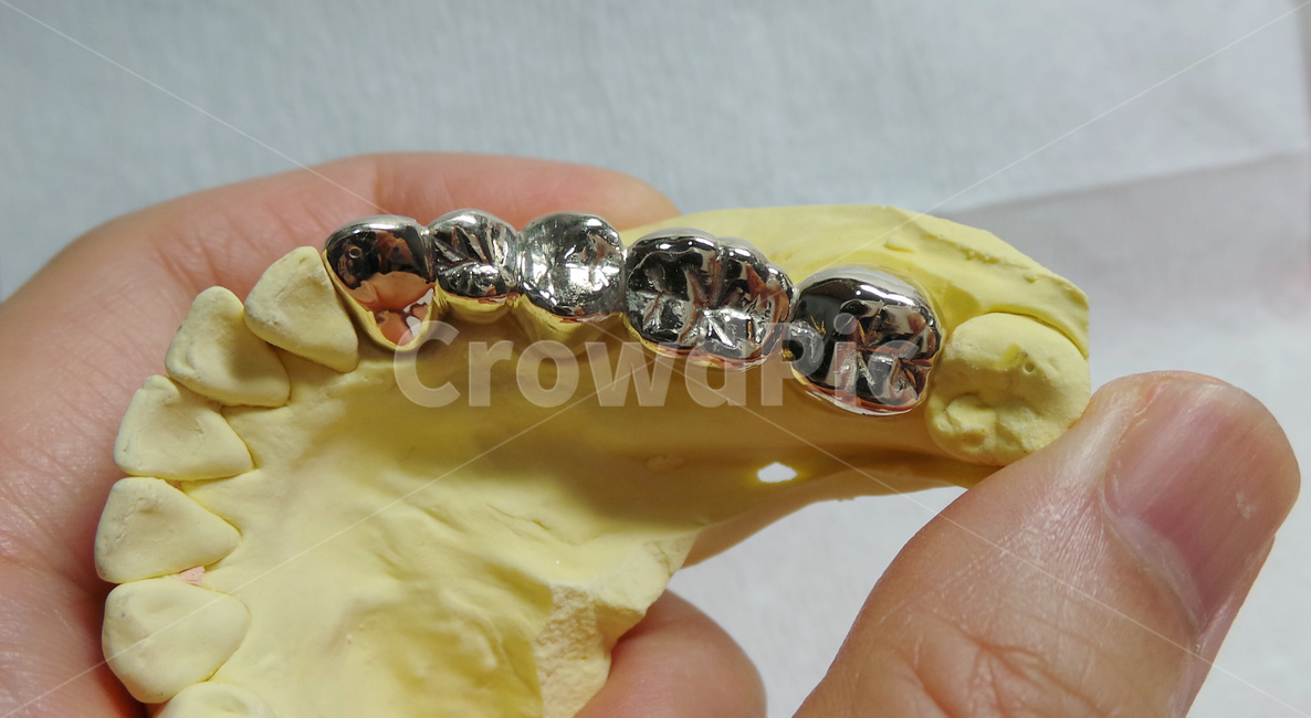 치과,크라운,골드,브릿지,dentist,보험,치아,보철,의료,의학,병원,medical,hospital,clinic