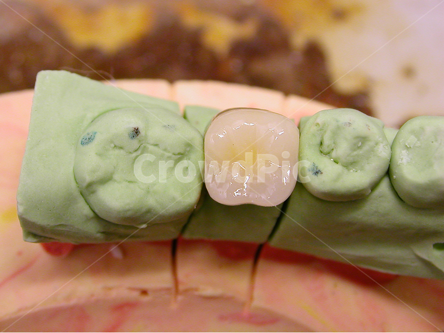 치과,보철,의료,성형,dental,어금니,치료,도자기,포세라인,이빨,치아,석고,치과기공,임플란트,implant,porcelain,zirconia,지르코니아,의료,의학,병원,medical,hospital,clinic