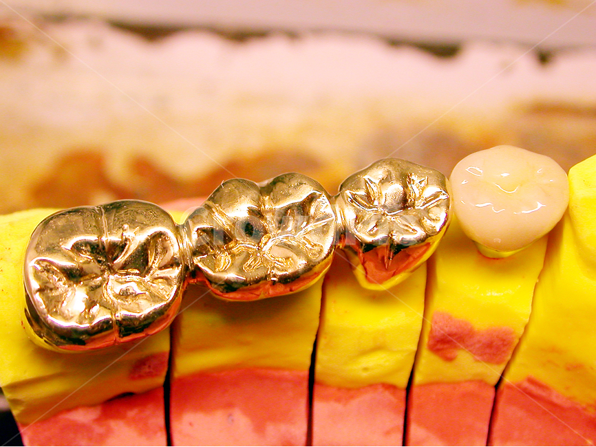금니,치과,의료,보철,크라운,치아,치과기공사,기공,덴탈,porcelain,gold,석고,병원,이빨,tooth,stone,입,기공사,골드브릿지,브릿지,골드,세공,광택,의료,의학,병원,medical,hospital,clinic,사물,물건,오브젝트,thing,object,matter