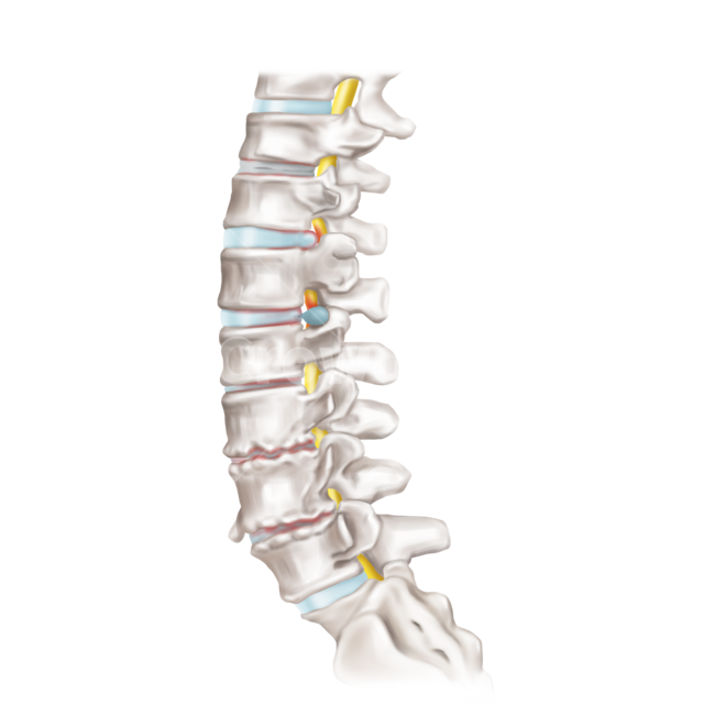 메디컬,medical,png,일러스트,메디컬일러스트,해부학,anatomy,bone,척추,디스크,추간판,경추,요추,흉추,디스크질환,병변,퇴행성,골극,탈출증,누끼,remove background