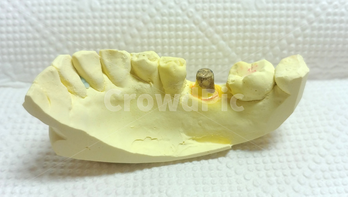 치과,치아모형,임플란트,덴탈,implant,보철,dental,석고
