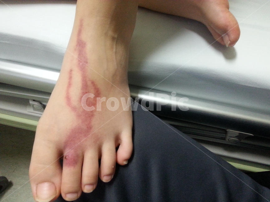 발혈관염,발혈관,림프관염,발감염,발감염1일차,혈관염,foot,human,bloodvessel,avein,사람,인간,발가락,의료,의학,병원,medical,hospital,clinic