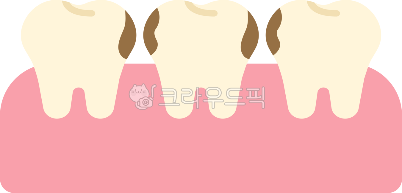 사이충치,치아사이충치,이빨사이충치,충치,상한이,썩은이,얕은충치,이빨,치아,치과,썩은치아,썩은이빨,충치일러스트,충치모형,충치삽화,치과치료,신경치료,충치신경치료,dental,dentist,cavity,tooth,teeth