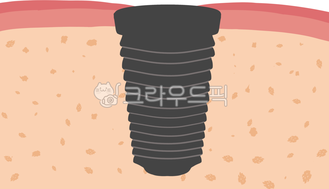 Implants,crowns,teeth,dentistry,bridges,treatment,gums,stitches,gum inflammation,periodontal disease,alveolar bone,secondary,molars,zirconia