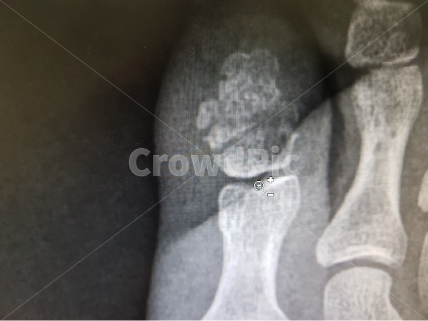 xray,병원,골절,발가락,뼈,의료,치료,환자,기브스,보험,건강,건강보험,안전사고,과실,의료,의학,병원,medical,hospital,clinic