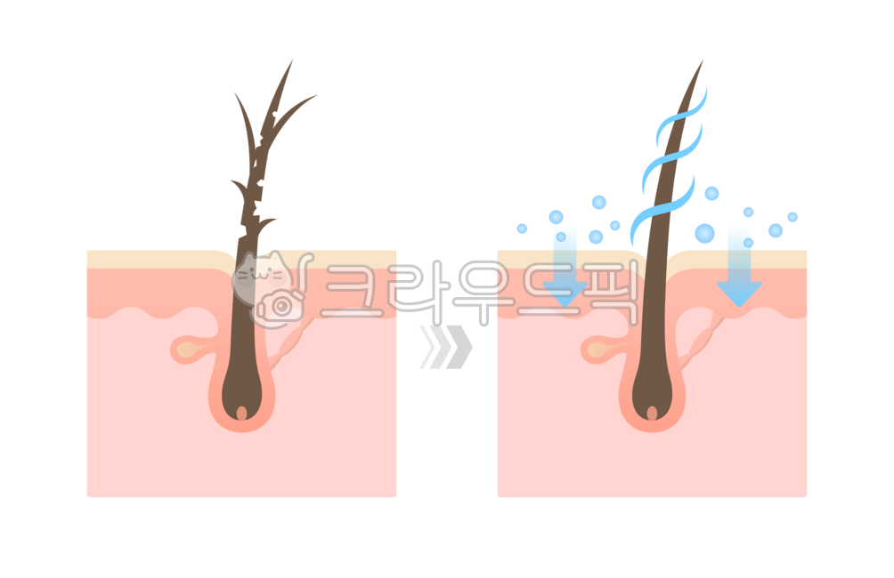Hair,hair,problem,trouble,damage,split ends,hair root,hair follicle,hair,nutrition,nutrients,treatment,vitamin,management,absorption,care,hair care,hair,scalp,epidermis,dermis,surface,skin,anatomy,anatomy,structure,part,cross se